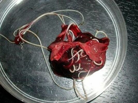 Würmer im menschlichen Körper